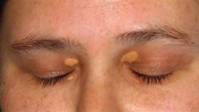 Xanthelasma